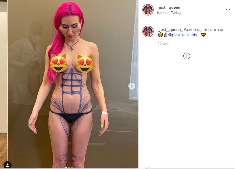 Instagram; Anastasia Pokreshchuk cirugías plásticas.