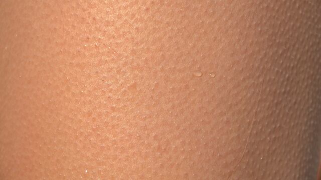 Granos en los brazos, un grave problema de salud.