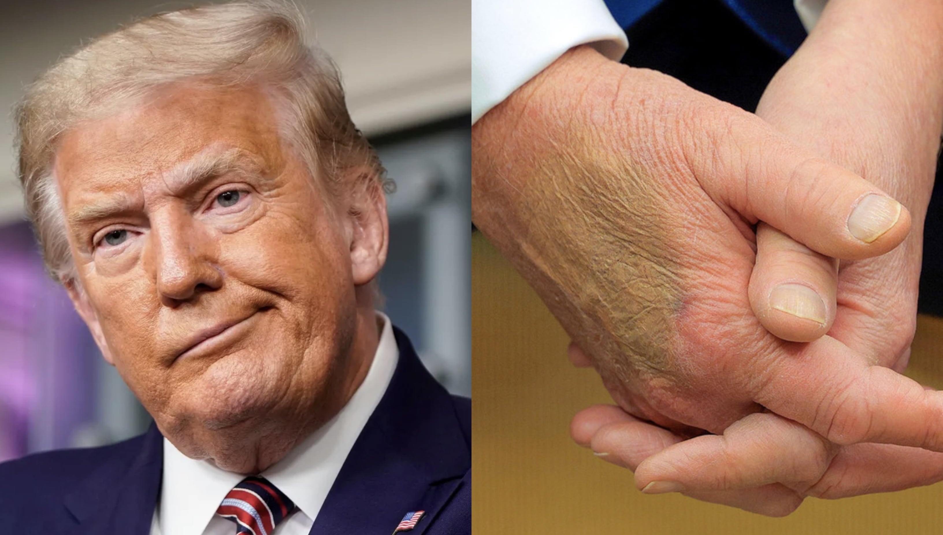 Moretón en la mano de Donald Trump