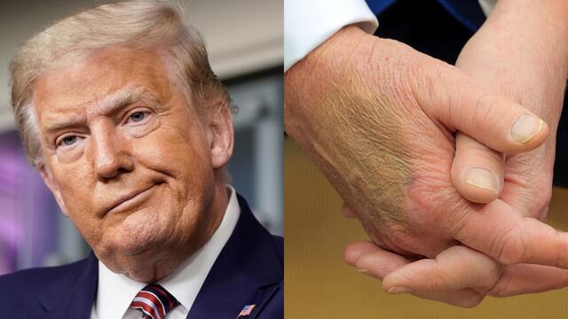 Moretón en la mano de Donald Trump