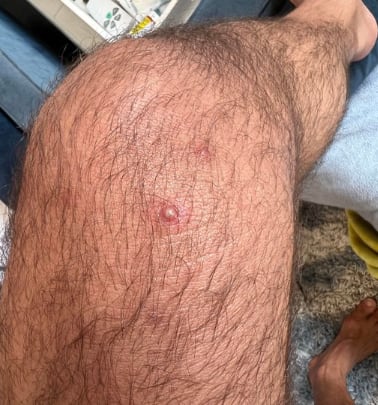 Actor porno con Viruela del Mono