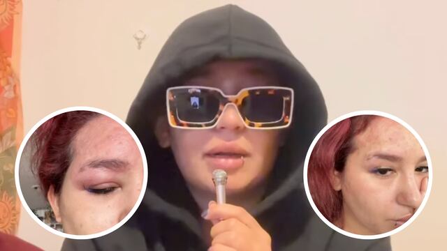 Romina Marcos tiene herpes zoster