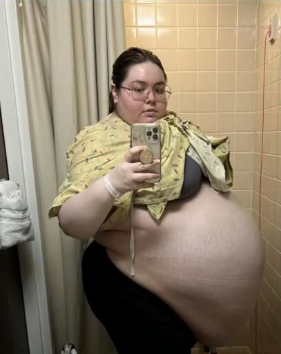 Allison Fisher, la mujer que pensó tenía obesidad pero estaba cargando un quiste de 50 kilos