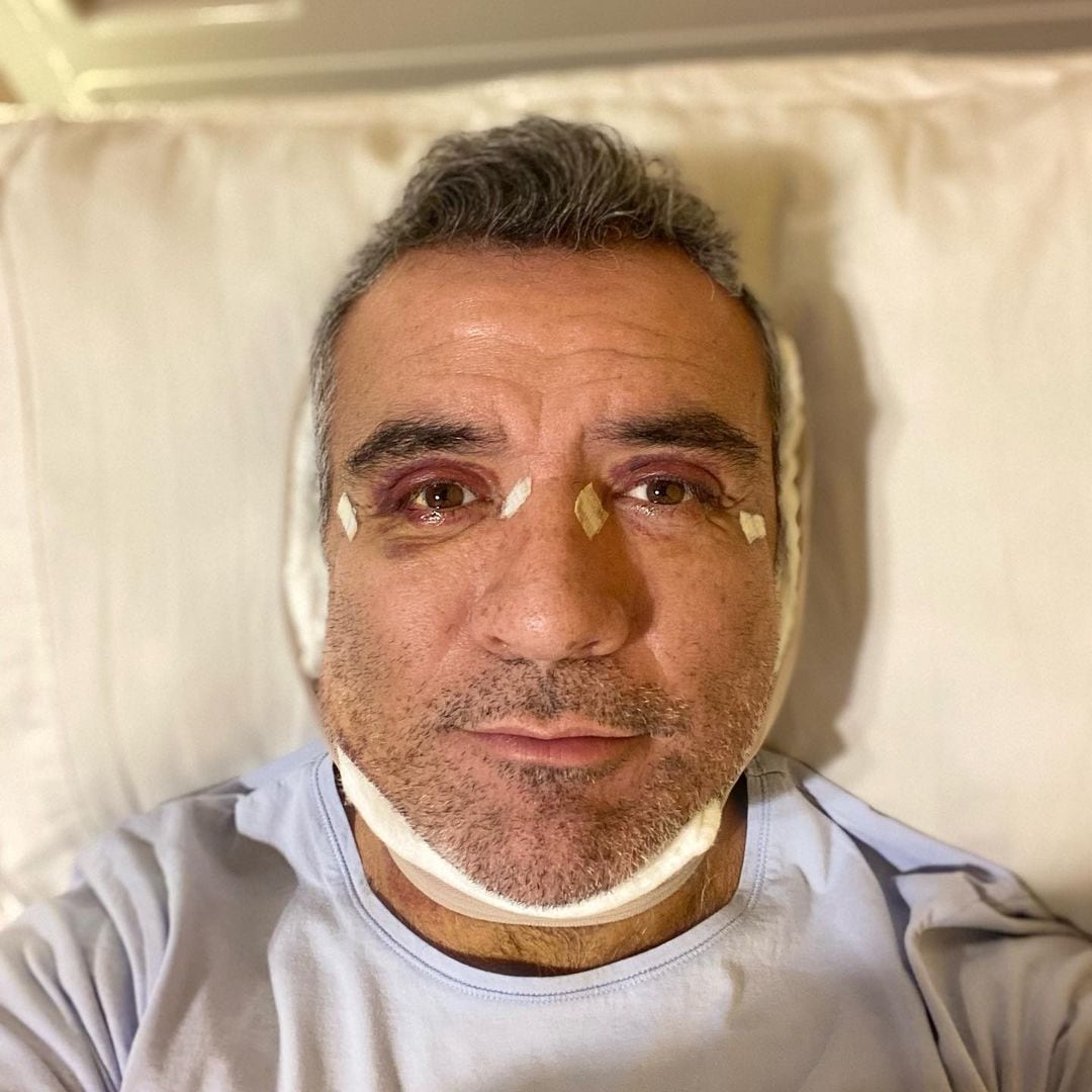 Héctor Sandarti aparece con moretones en el rostro.