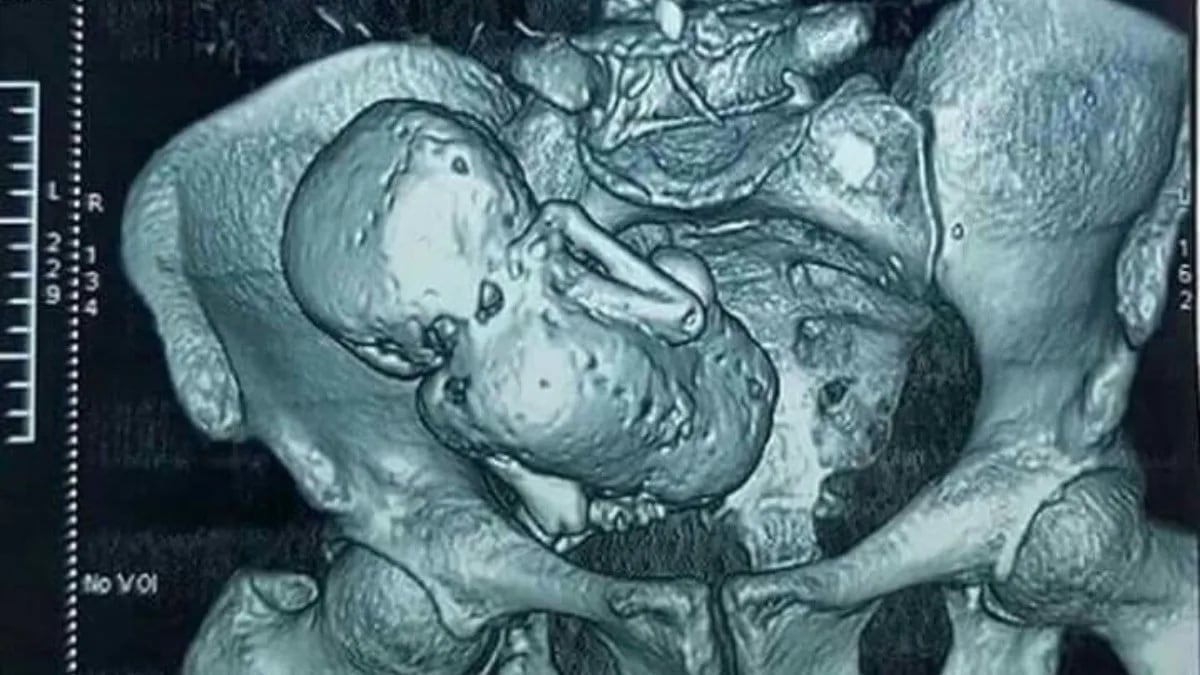 ¿Qué es litopedia? El feto calcificado tiene una explicación