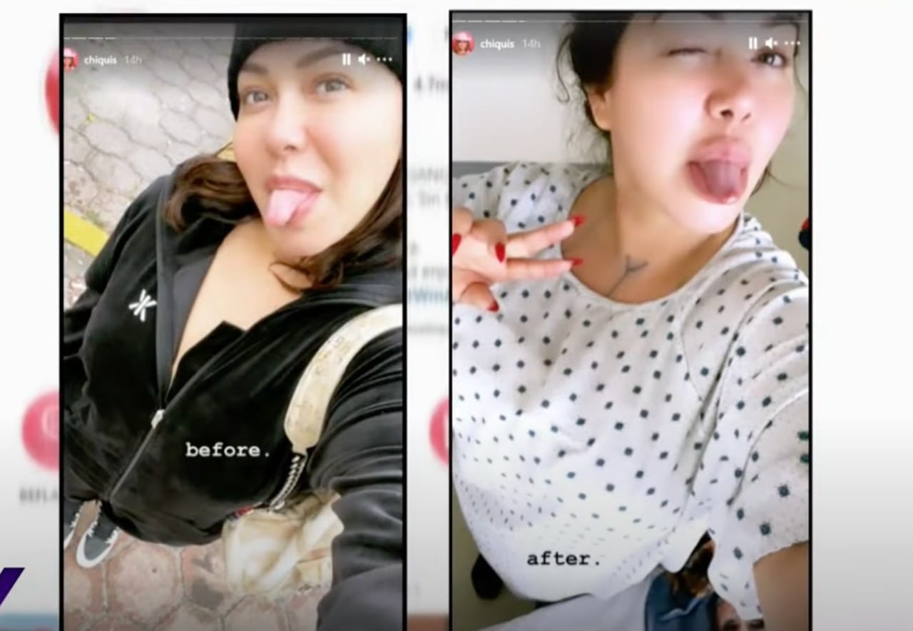 Chiquis Rivera antes y después de su cirugía de senos.