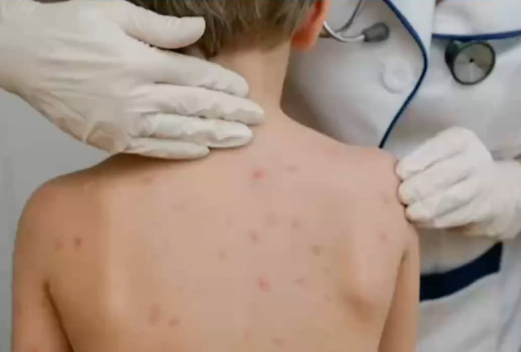 CDMX precisa edad del menor fallecido por sarampión