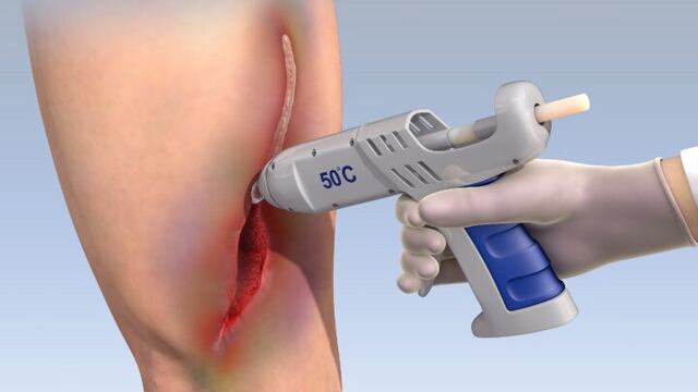 Crean pegamento médico no tóxico, capaz de sanar heridas graves.