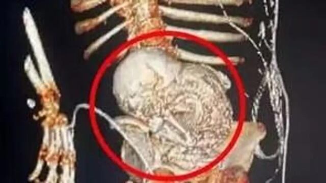 ¿Qué es litopedia? El feto calcificado tiene una explicación