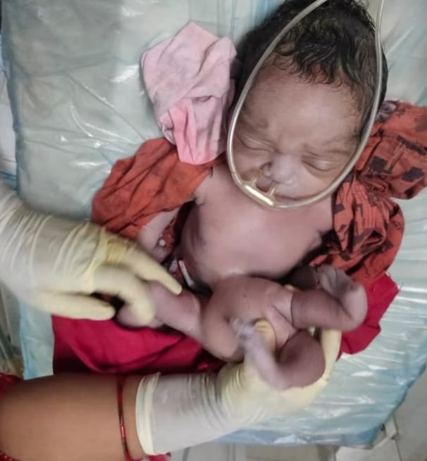 Bebé con 4 piernas y 4 brazos