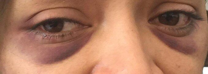 Moretones en el rostro de la comunicadora.