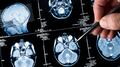 El día internacional contra el cáncer cerebral