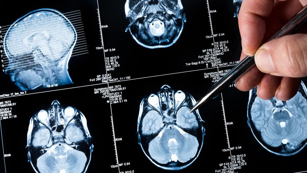 cerebro no está exento de poder desarrollar tumores o cáncer.