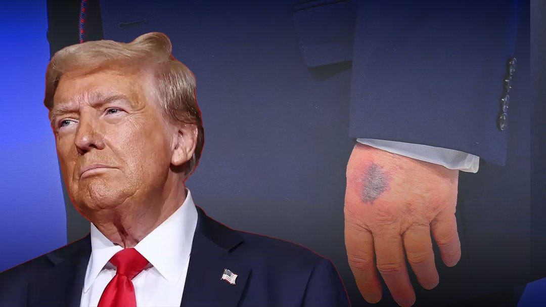 Donald Trump aclara el origen de los moretones en sus manos