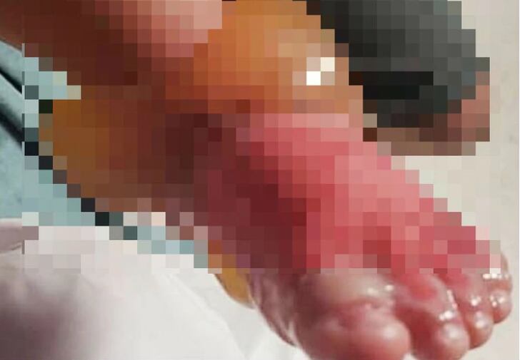 Kaylee sufrió quemaduras de tercer grado