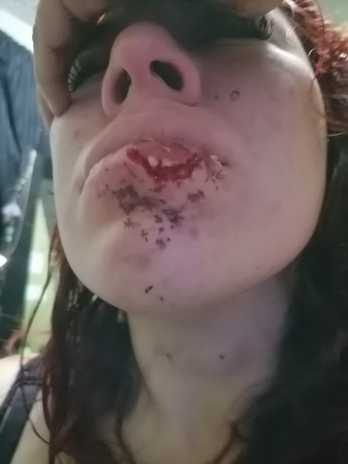 A mujer le arrancan labio inferior