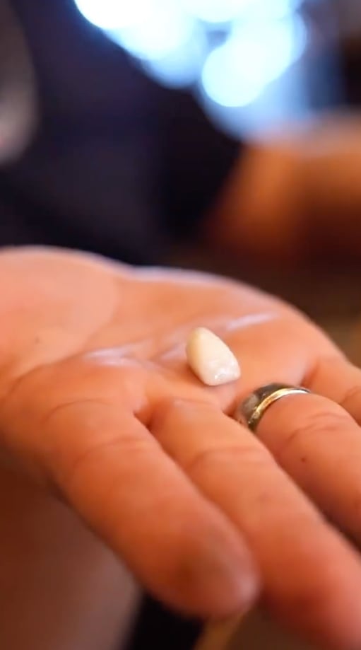 Larry Hernández muestra el diente que se le cayó.