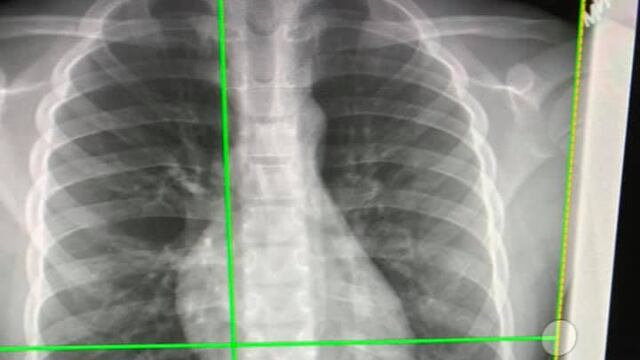 Niño va a parar al hospital por tragarse sus AirPods