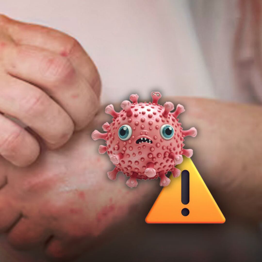 Brote de sarampión: una nueva plaga que viene de Estados Unidos