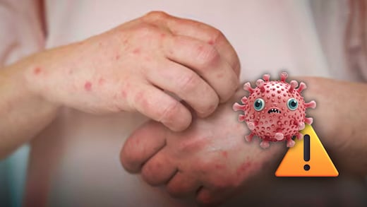 Brote de sarampión: una nueva plaga que viene de Estados Unidos