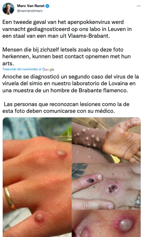 Reportan dos casos de viruela del mono en Bélgica