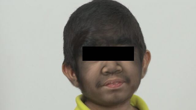 Bebés se contagian con síndrome del hombre lobo por omeprazol alterado