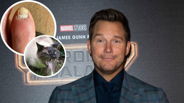 Chris Pratt tiene hongo en la uña del pie y lo exhibió porque quiso.
