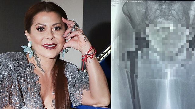 Alejandra Guzmán muestra prótesis de cadera