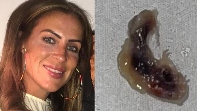 Louise Edwards tenia un parásito en el ojo