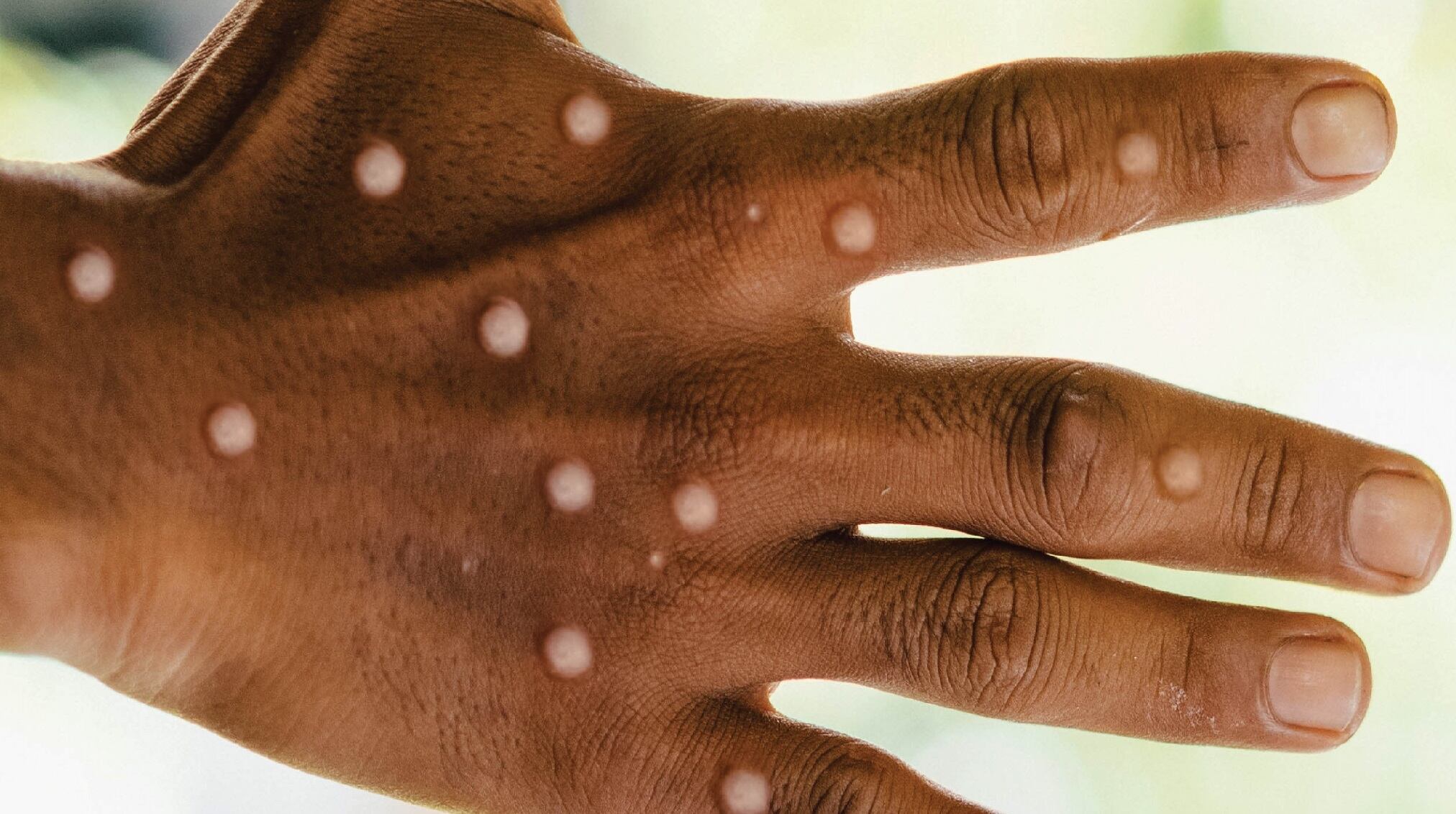 ¿Virus Mpox es la nueva emergencia sanitaria global? OMS tomará pronto una decisión