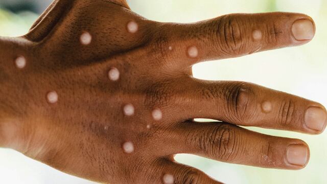 ¿Virus Mpox es la nueva emergencia sanitaria global? OMS tomará pronto una decisión