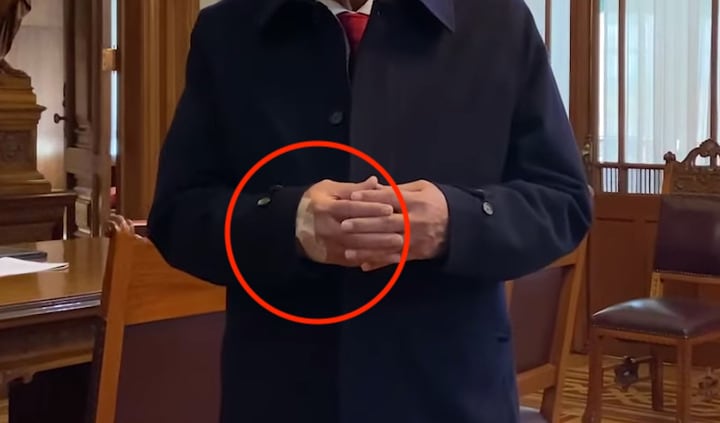 Vendaje en la mano de AMLO