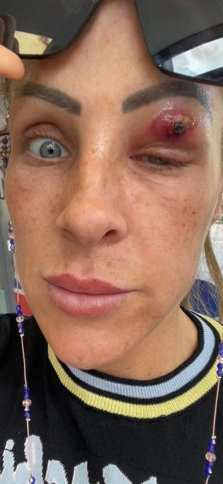 Louise Edwards tenia un parásito en el ojo