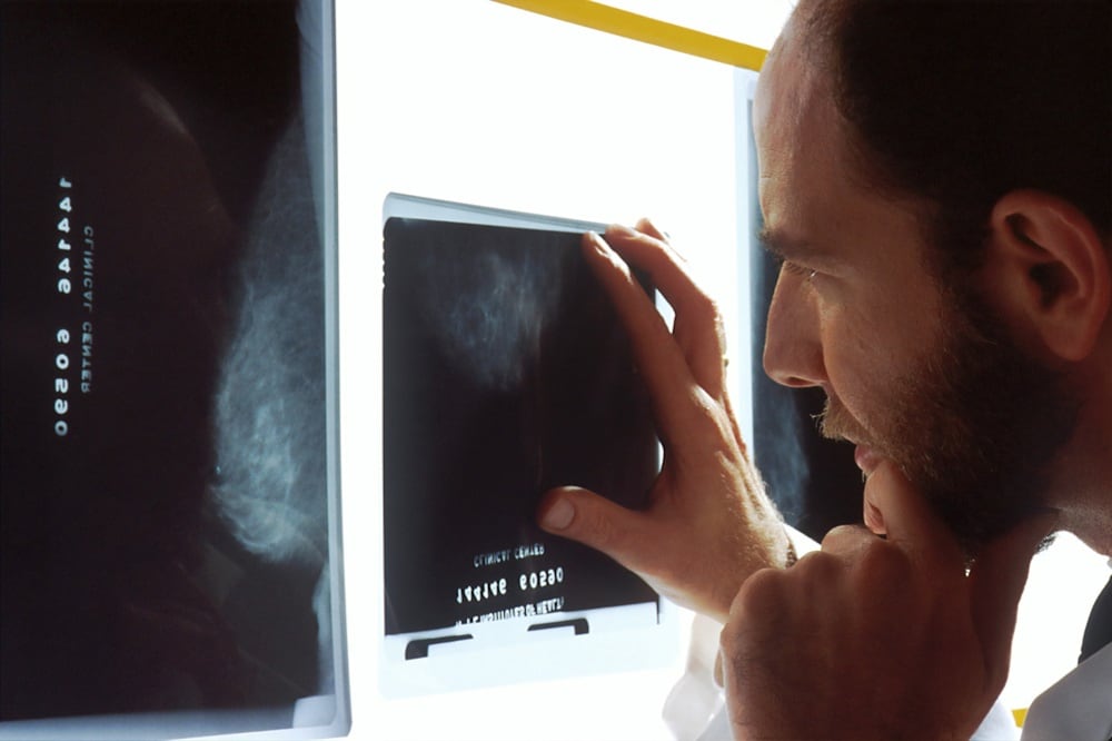 Cáncer de mama en hombres