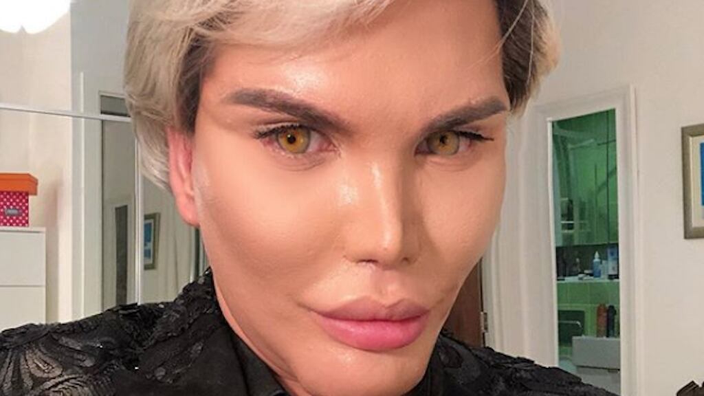 'Ken humano' sufre porque se le rompió su implante de mentón