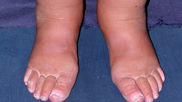 Linfedema en piernas