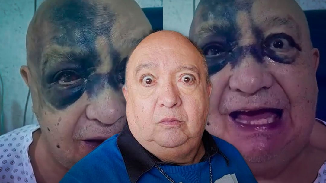 ¿Qué le pasó a Luis de Alba? Actor sufre lesiones en el rostro tras accidente