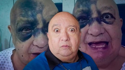¿Qué le pasó a Luis de Alba? Actor sufre lesiones en el rostro tras accidente