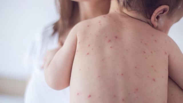 Sarampión en niños: síntomas y por qué puede ser mortal para los más pequeños