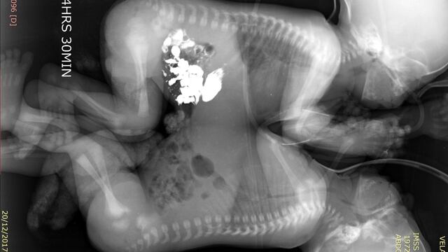 Siameses unidos por tórax y abdomen