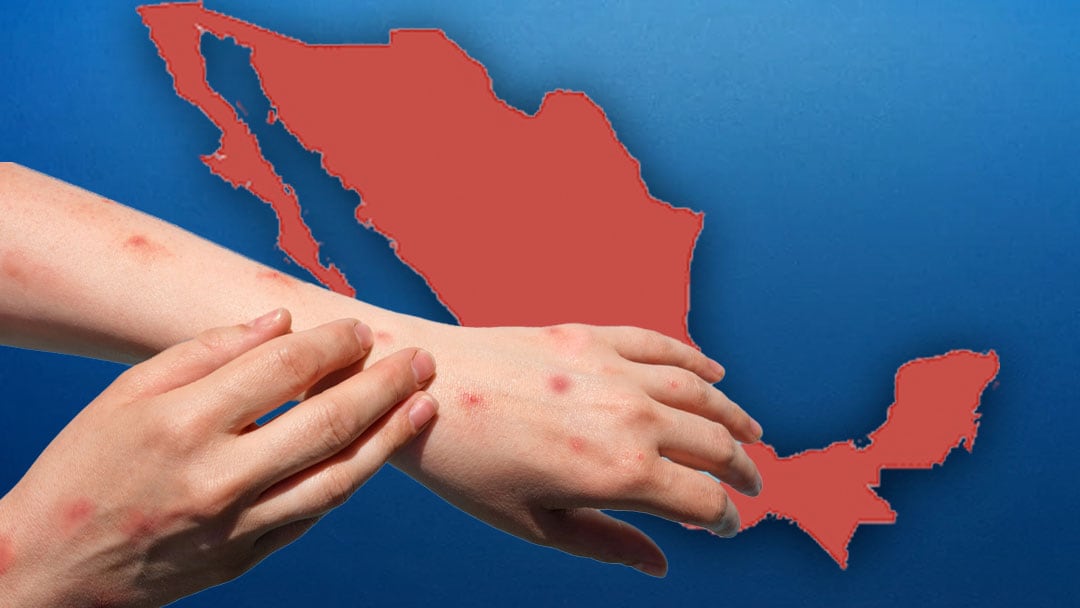 Sarampión en México hoy 11 de abril 2025