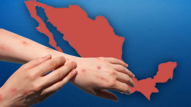 Sarampión en México hoy 11 de abril 2025