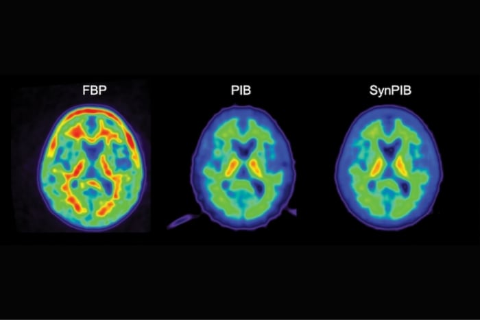 La Arizona State University (ASU) realiza importantes avances en el estudio del Alzheimer.