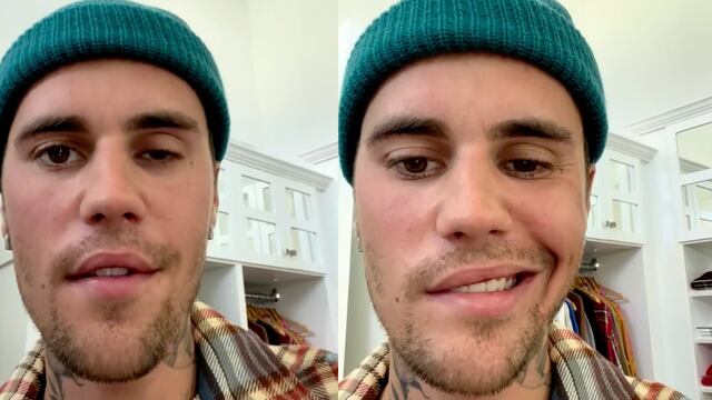 Justin Bieber sufre parálisis facial