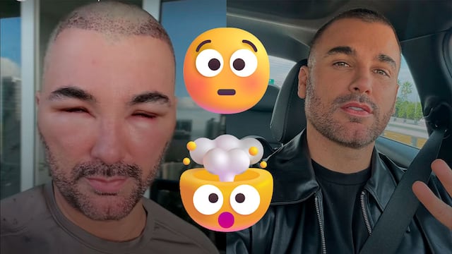 Mauricio Mejía apareció con todo el rostro hinchado por esta razón