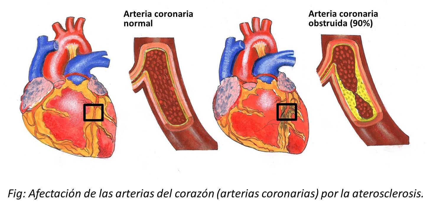 padecimiento de ateroesclerosis coronaria/internet