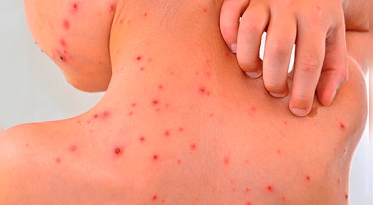 ¿Qué es la Rickettsia? Síntomas y cómo se cura la llamada “fiebre manchada”