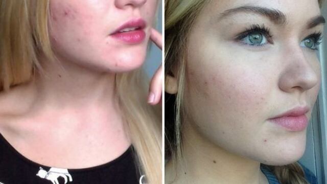 Mujer se deshace de los barros de la cara ¡sólo con miel!