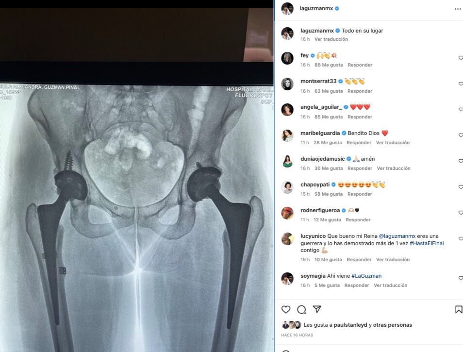 Alejandra Guzmán muestra radiografía de su cadera