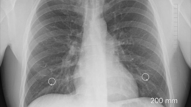 Radiografía de pulmón